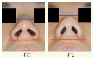 玻尿酸隆鼻效果怎么样