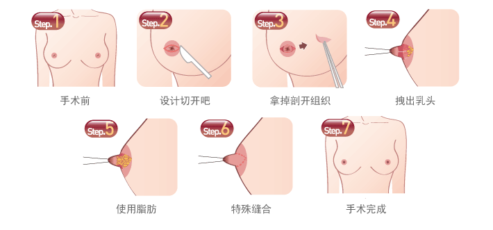 胸部整形过程