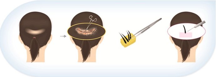 为什么说要慎重进行毛发种植