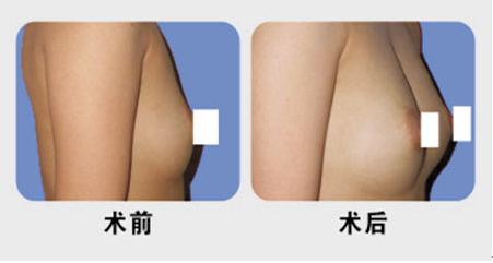 乳房再造对比图