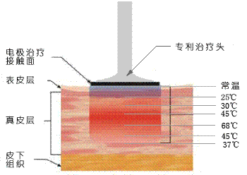 电波拉皮除皱效果怎样