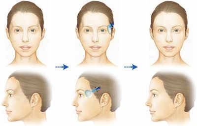 玻尿酸注射太阳穴