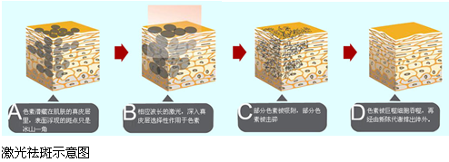 激光去黄褐斑时间长吗