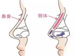 隆鼻失败有什么症状