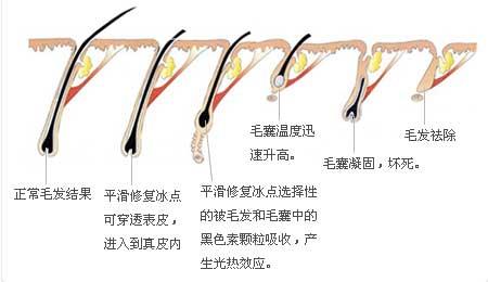 武汉有哪些脱毛方法