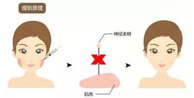 瘦脸后会咬肌无力吗