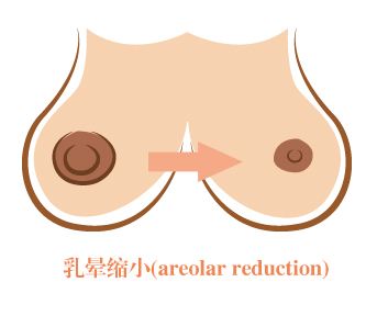 做乳晕缩小术前应该做什么