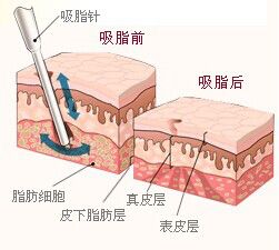 武汉吸脂减肥疼不疼