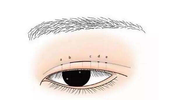 埋线双眼皮