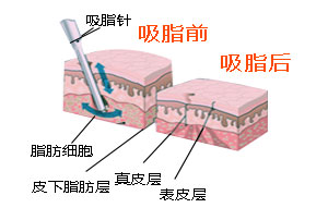 双下巴可以做吸脂吗