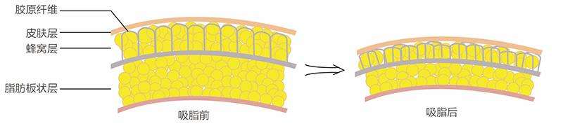面部吸脂优点有哪些