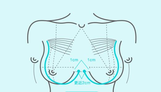 武汉丰胸术能改善乳房下垂吗