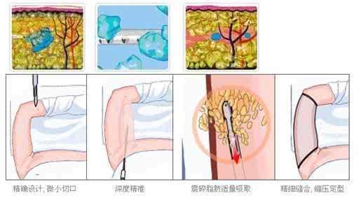 武汉腰腹部吸脂的效果如何?