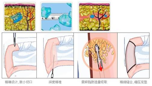 武汉手臂吸脂后怎么护理?