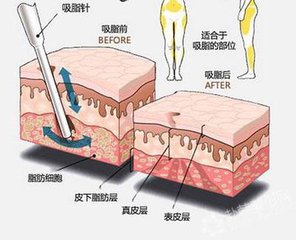 武汉大腿吸脂的效果怎么样?