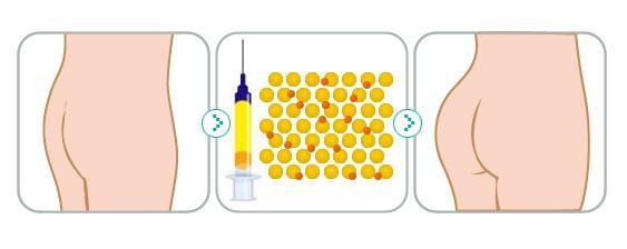 武汉自体脂肪丰臀有哪些好处?