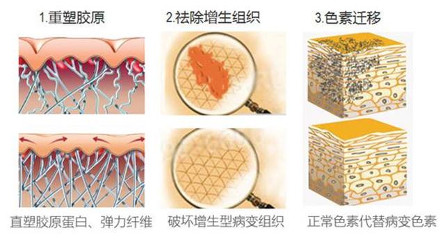 彩光嫩肤技术能祛疤吗?