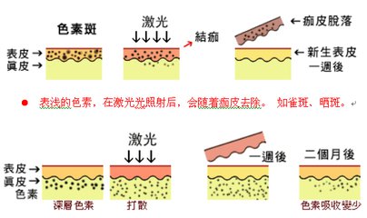 武汉激光祛雀斑效果持久吗?