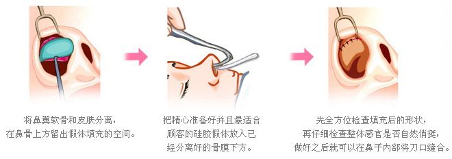 武汉韩式隆鼻会有副作用吗?