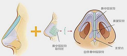 武汉韩式隆鼻如何快速消肿?