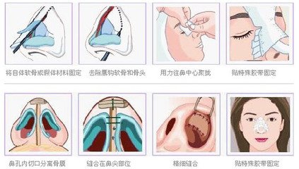 武汉韩式隆鼻大概多少钱?