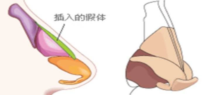 武汉韩式隆鼻吗?