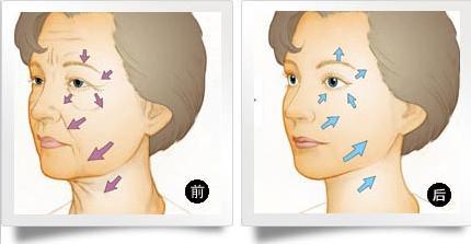 武汉射频除皱效果有哪些