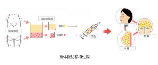 武汉自体脂肪隆鼻注射一次的价格是多少?