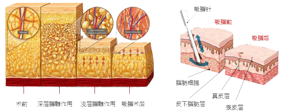 武汉手臂吸脂痛吗?