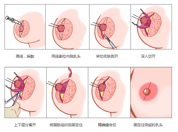 武汉有什么方法可以矫正乳头内陷?