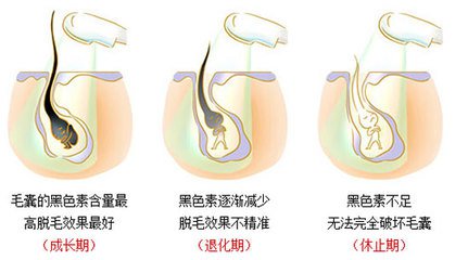 武汉激光脱唇毛有疼痛感吗?