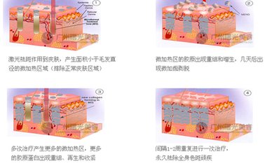 武汉激光祛斑大概要花多少钱?