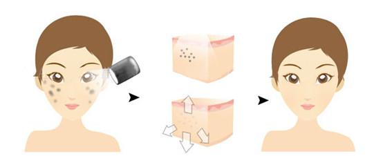 武汉皮秒祛斑是怎么操作的