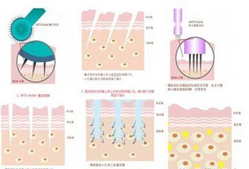 武汉去痘痘能用美塑吗?