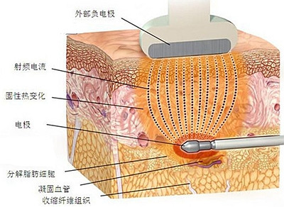 如何快速瘦身快?