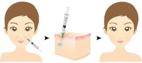 武汉玻尿酸去法令纹有哪些优点?