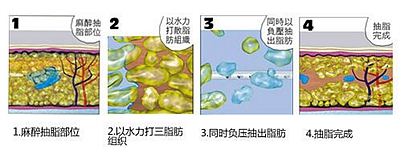 武汉水动力吸脂减肥后还会反弹吗?