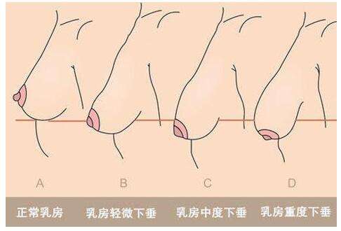 武汉乳房下垂有哪些原因