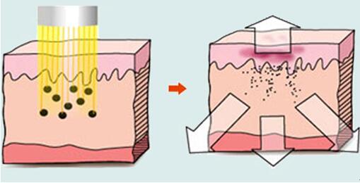 武汉激光是怎么去晒斑的呢